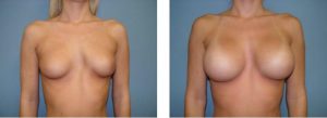 נתוח הגדלת חזה - תמונה לפני ואחרי 10